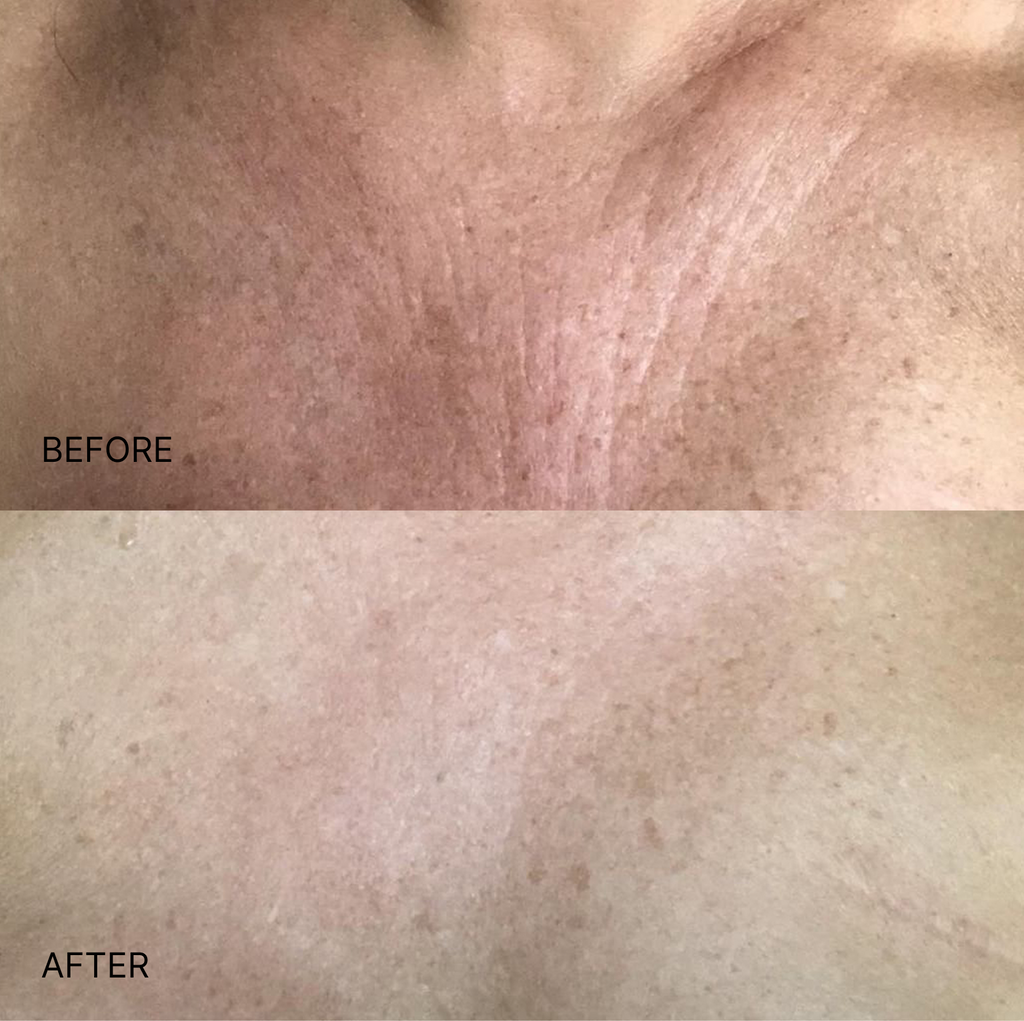 Wrinkle Smoothing Chest Patch