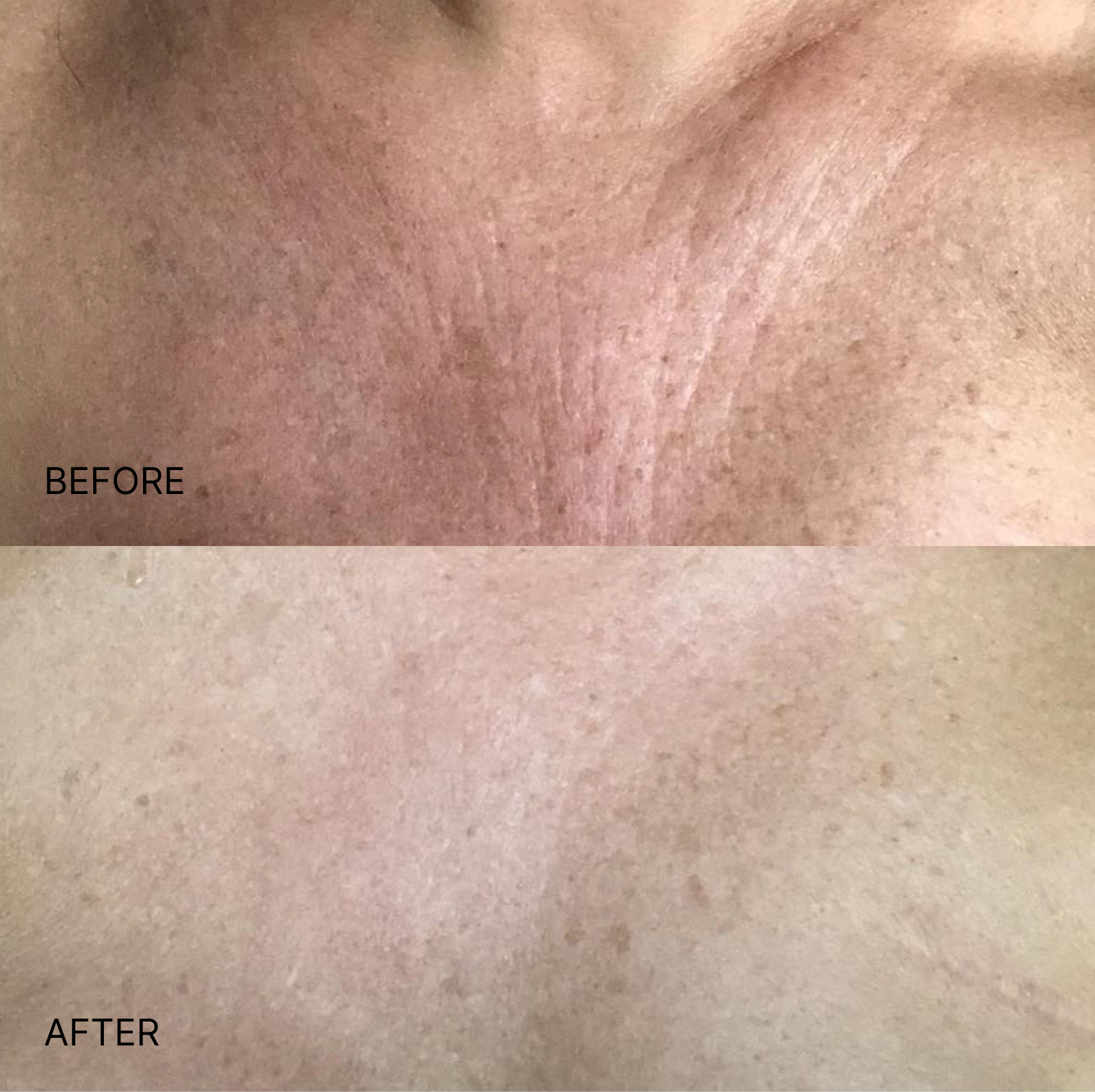 Wrinkle Smoothing Chest Patch