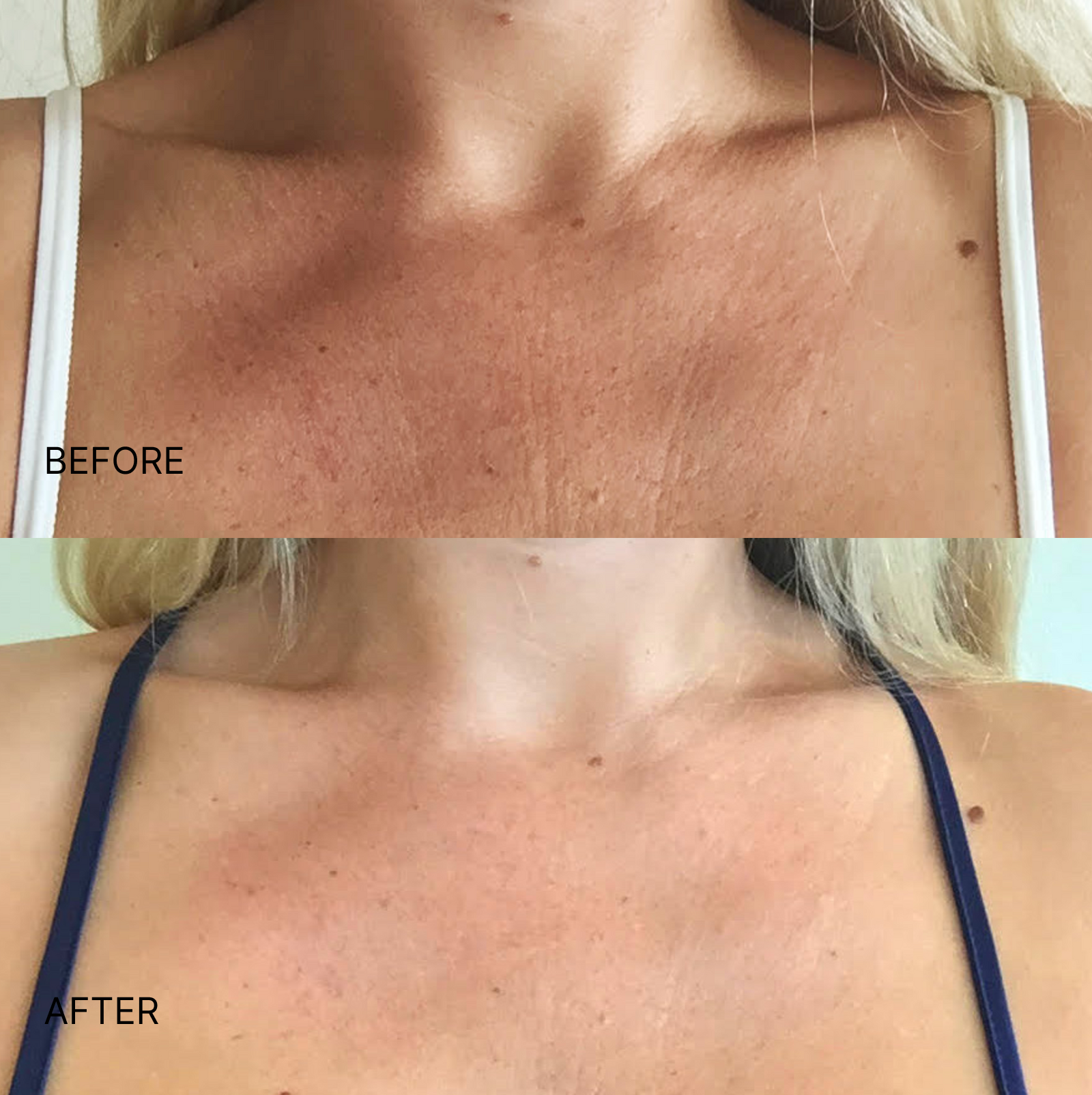 Wrinkle Smoothing Chest Patch