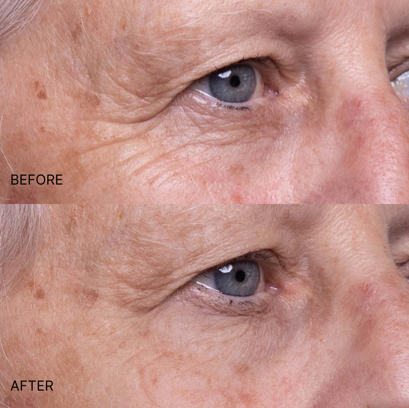 Wrinkle Smoothing Eyes & Smile Patches