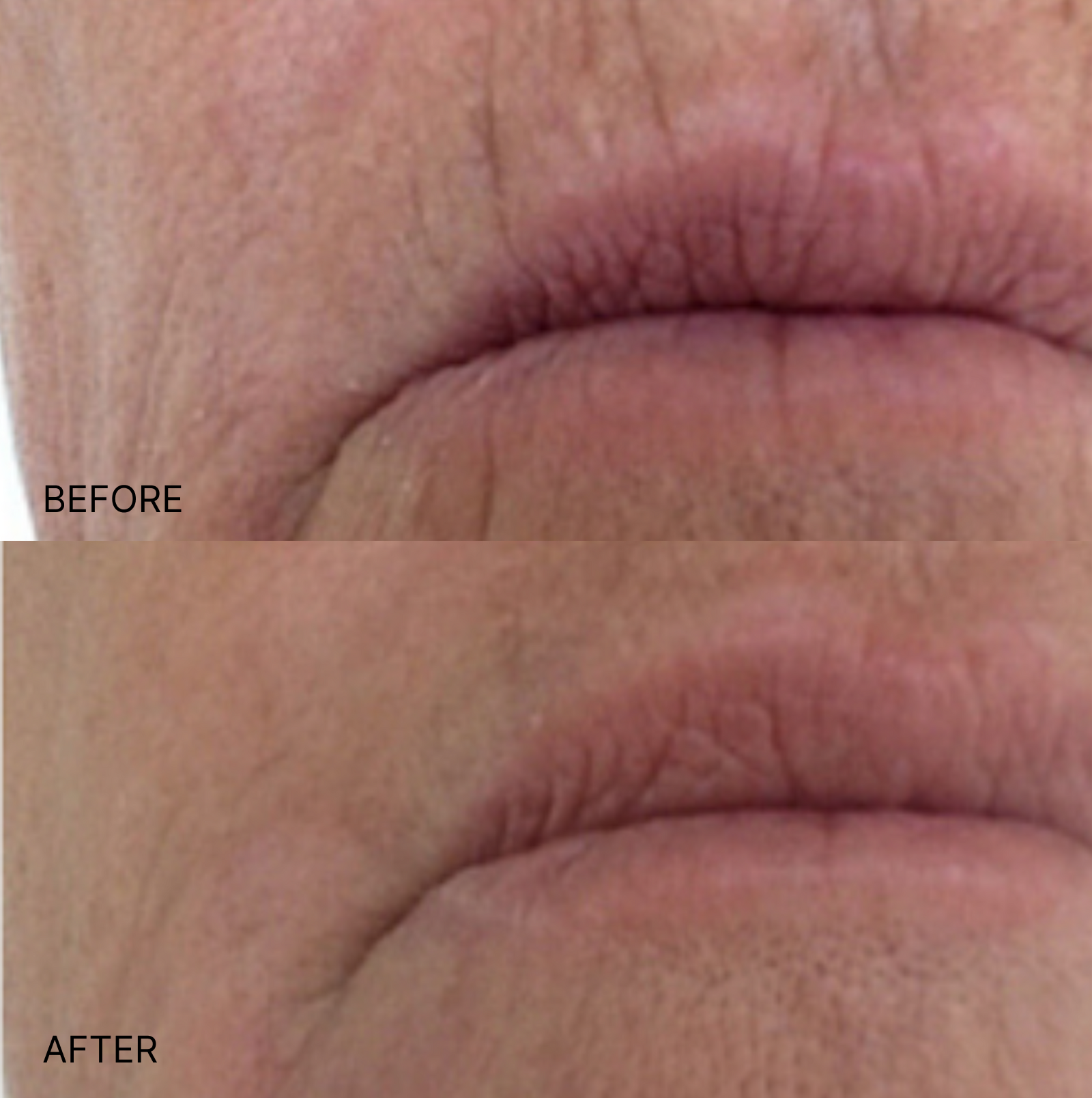 Wrinkle Smoothing Eyes & Smile Patches