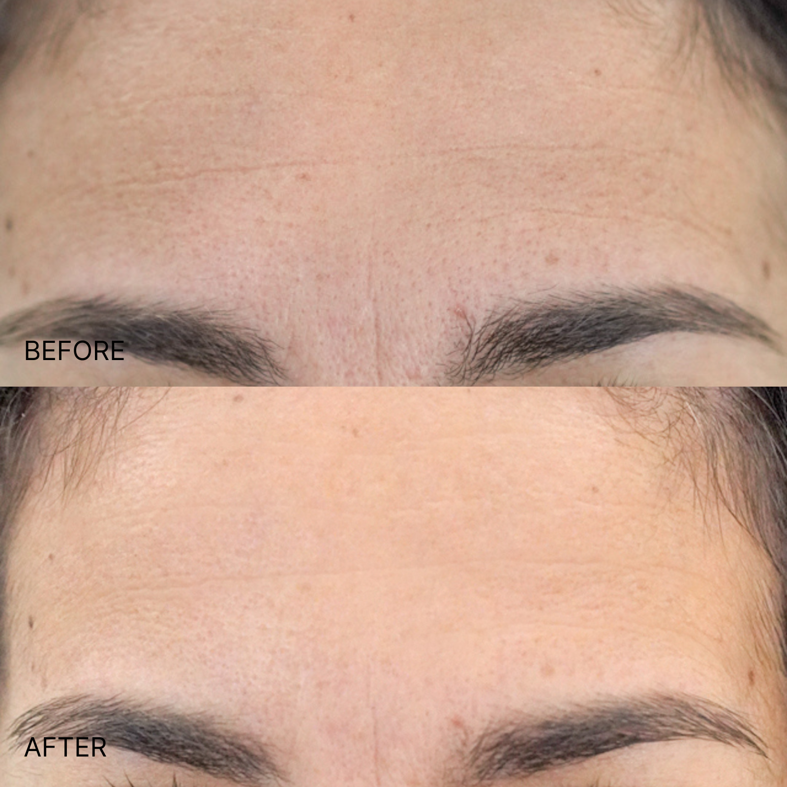 Wrinkle Smoothing Forehead Patch