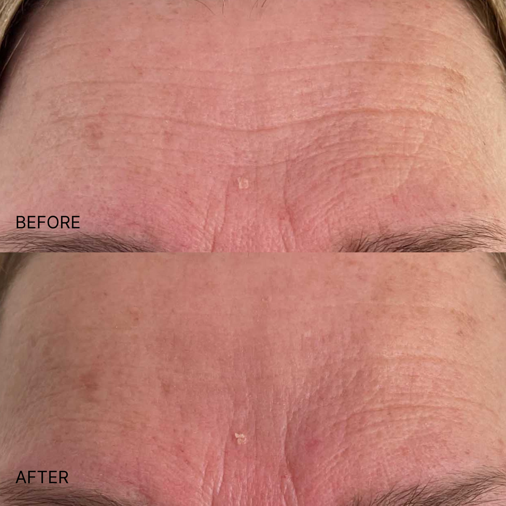 Wrinkle Smoothing Forehead Patch