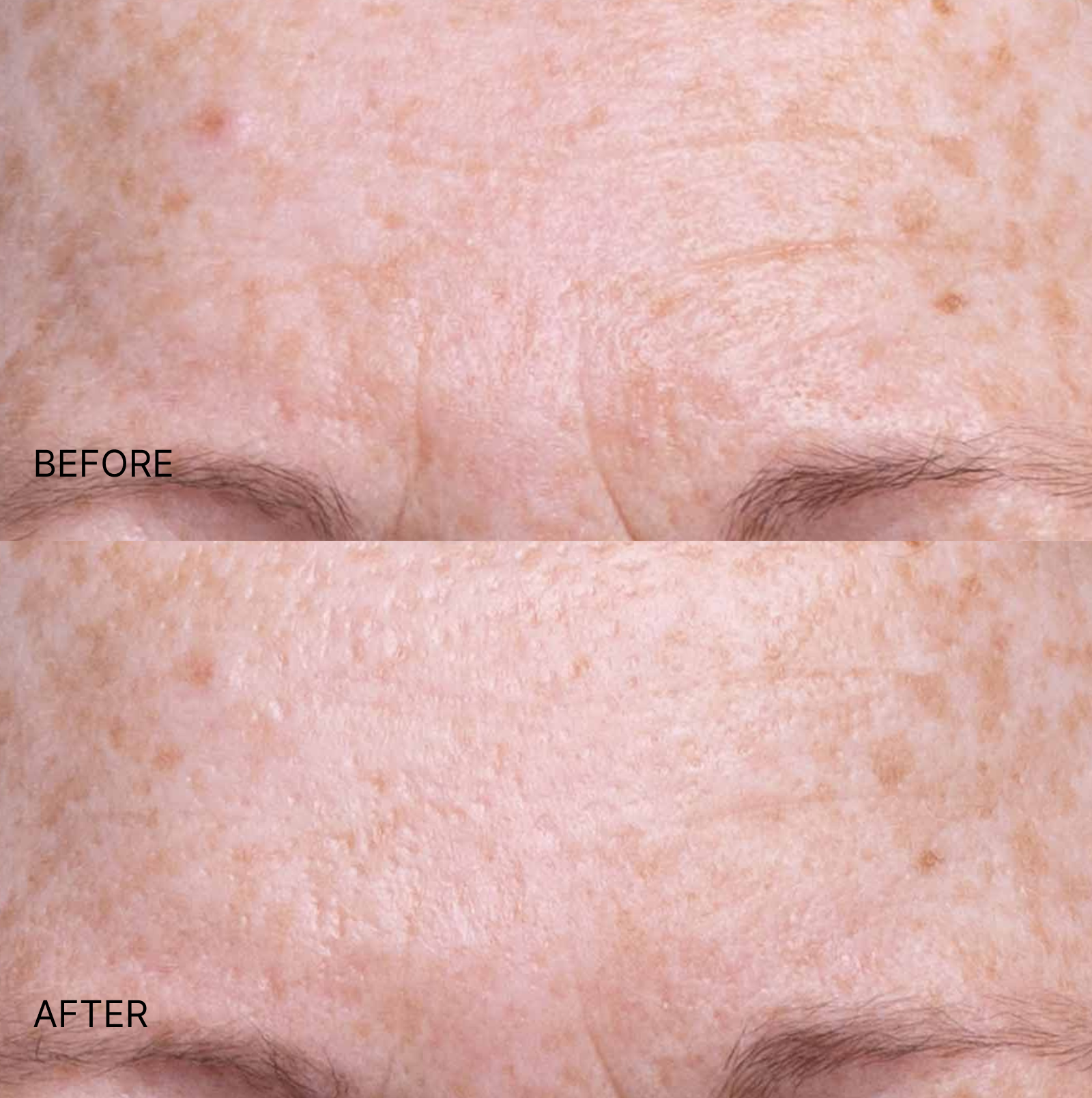 Wrinkle Smoothing Forehead Patch